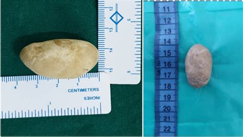 smegma stones|Preputial Calculus: Unveiling a Rare Encounter and Treatment。